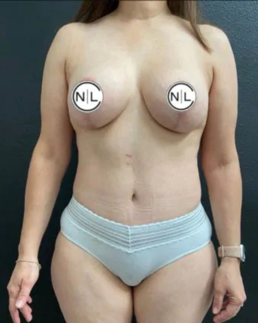 After Breast Implants