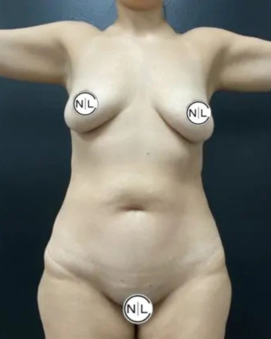 Before Breast Implants