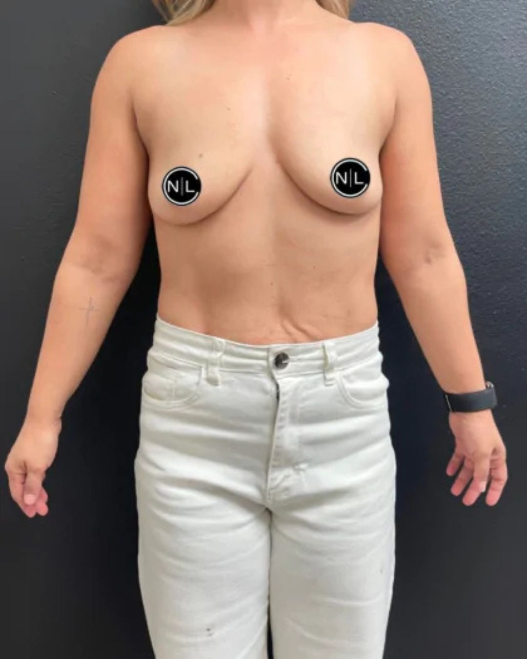 Before Breast Implants