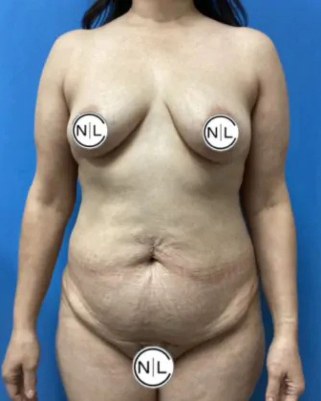 Before Breast Implants