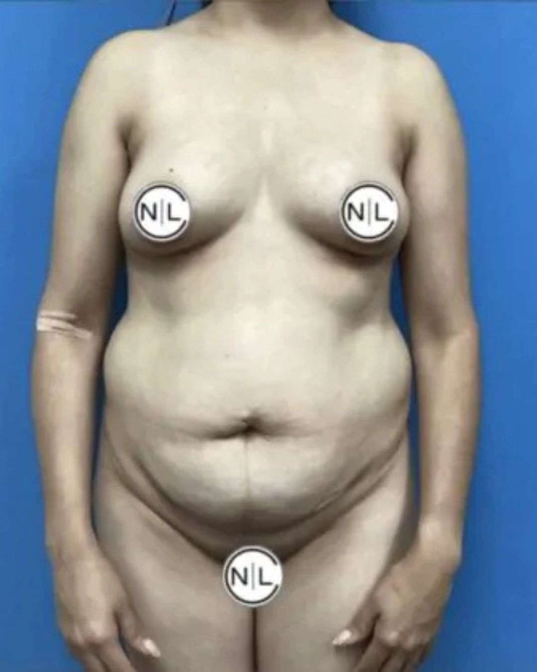 Before Breast Implants