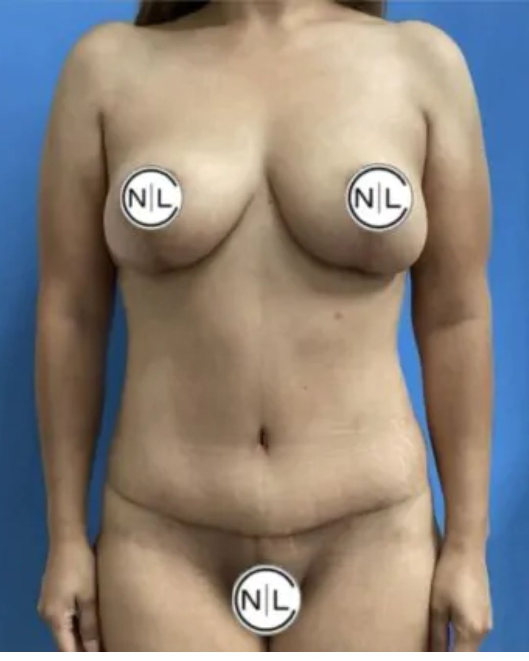 After Breast Lift