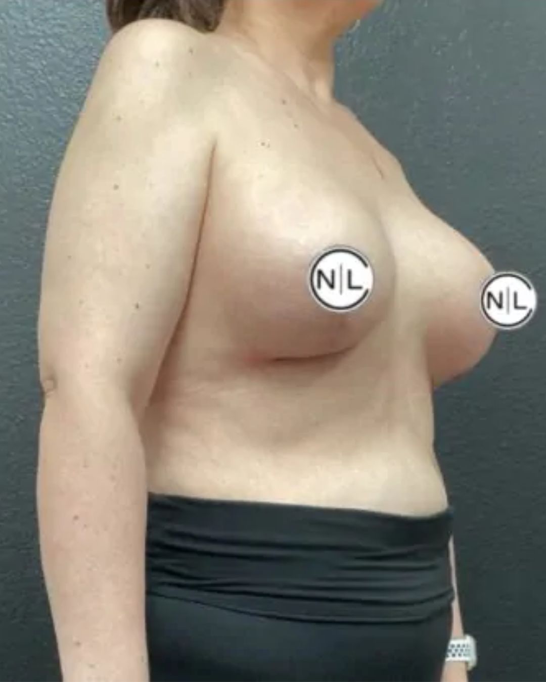 After Breast Lift