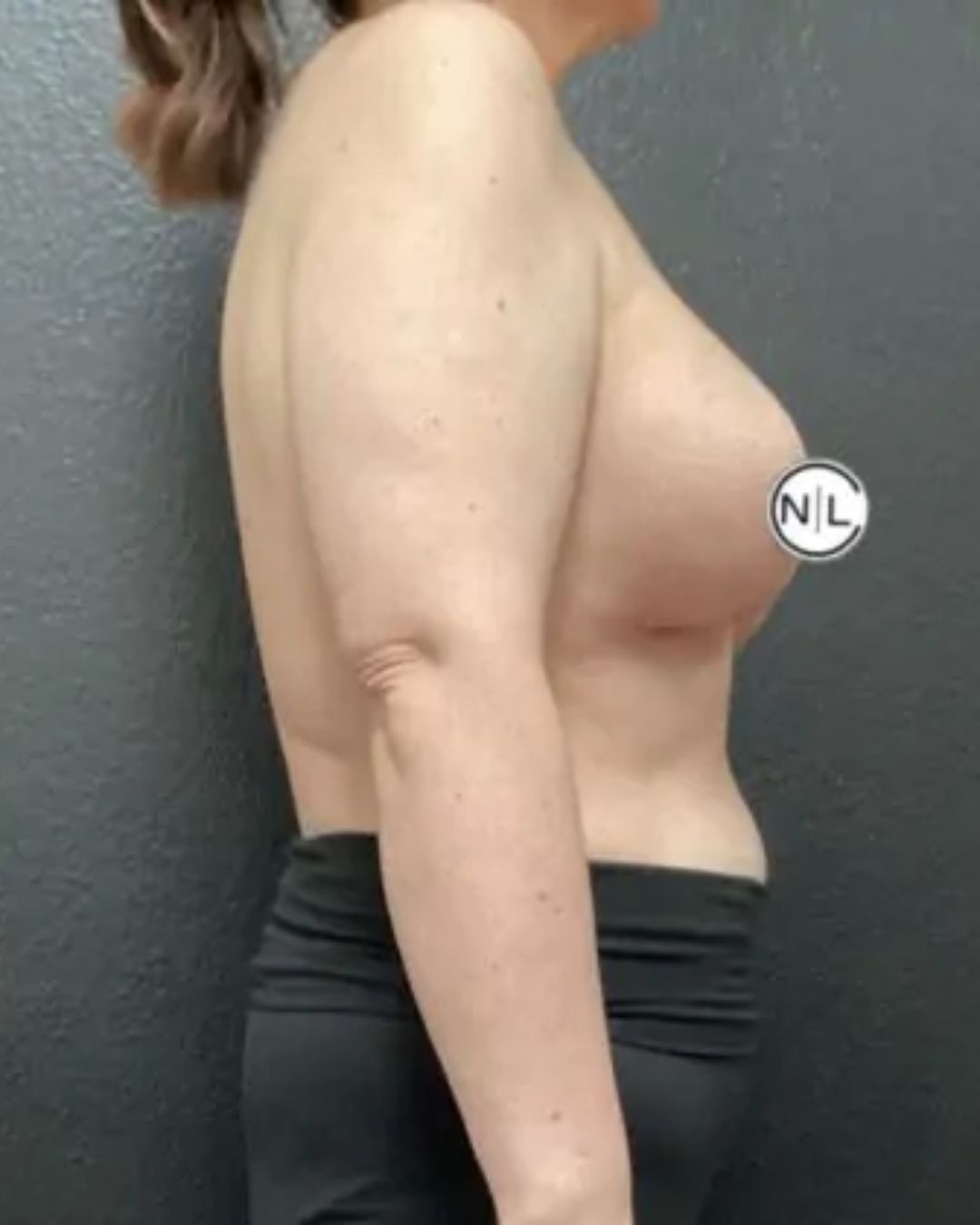After Breast Lift