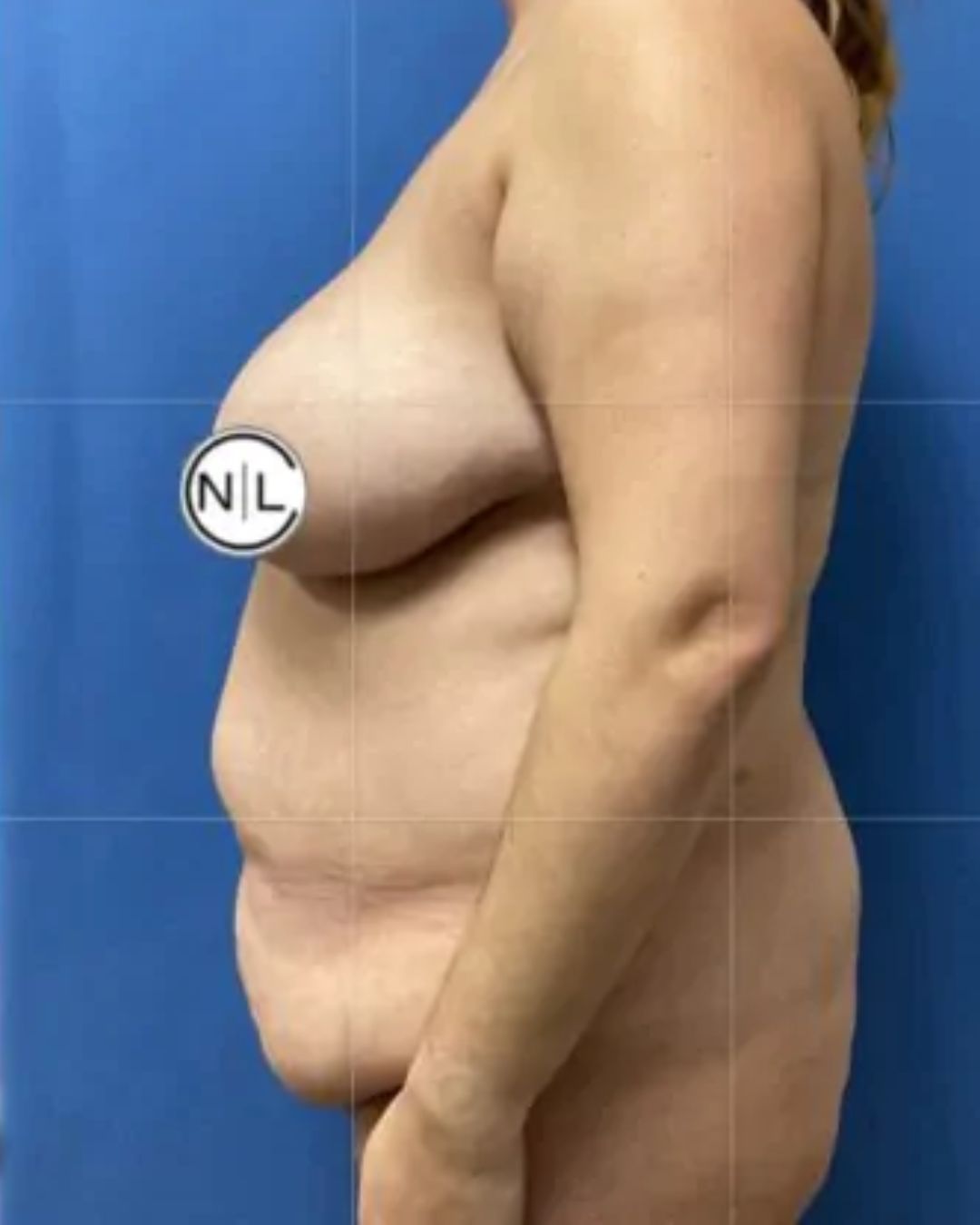 Before Breast Lift