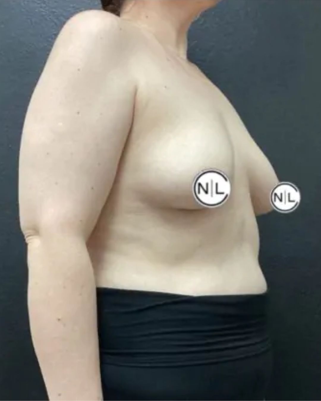 Before Breast Lift