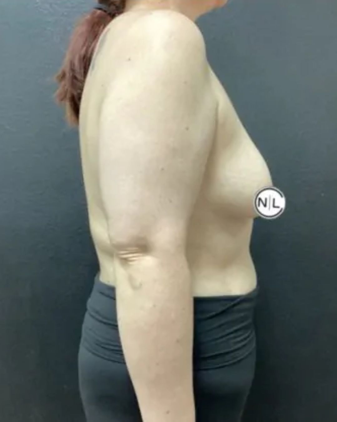 Before Breast Lift