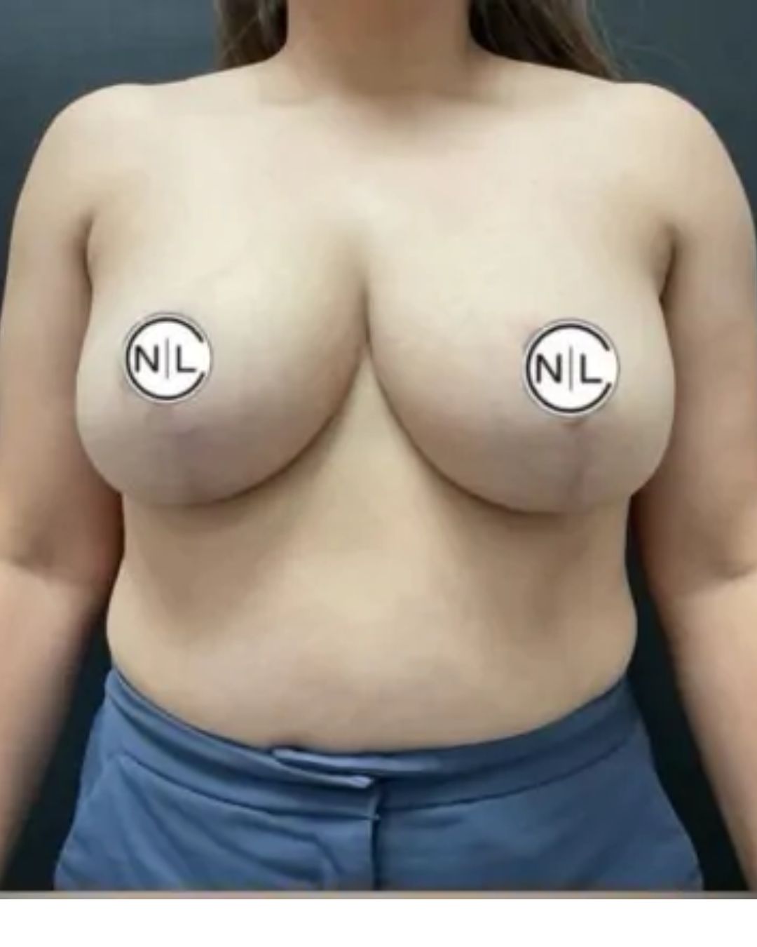 After Breast Reduction Surgery