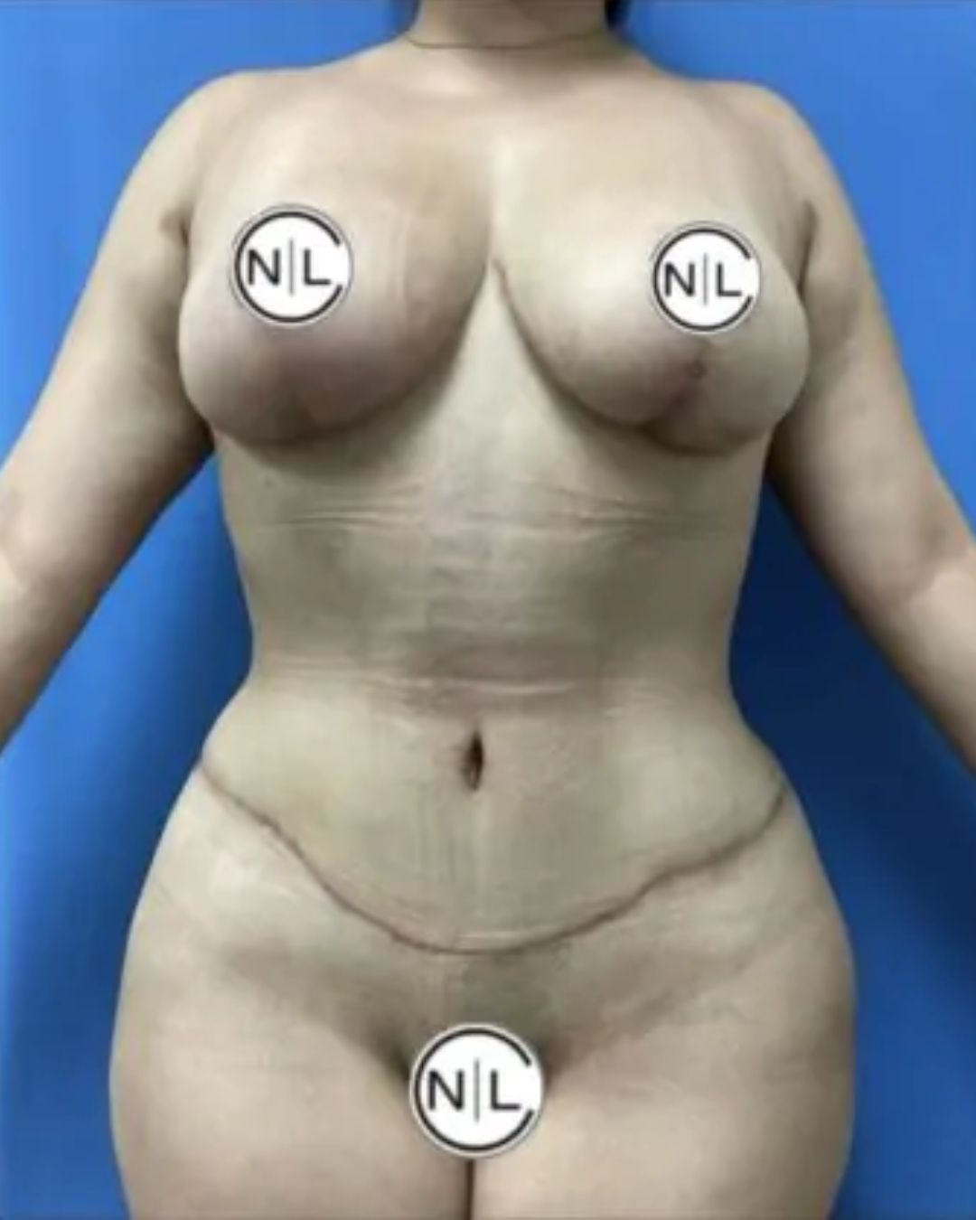 After Breast Reduction Surgery