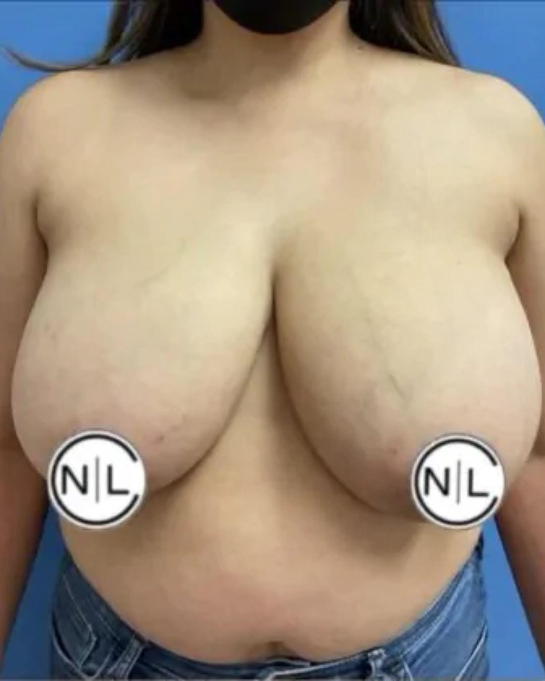 Before Breast Reduction Surgery