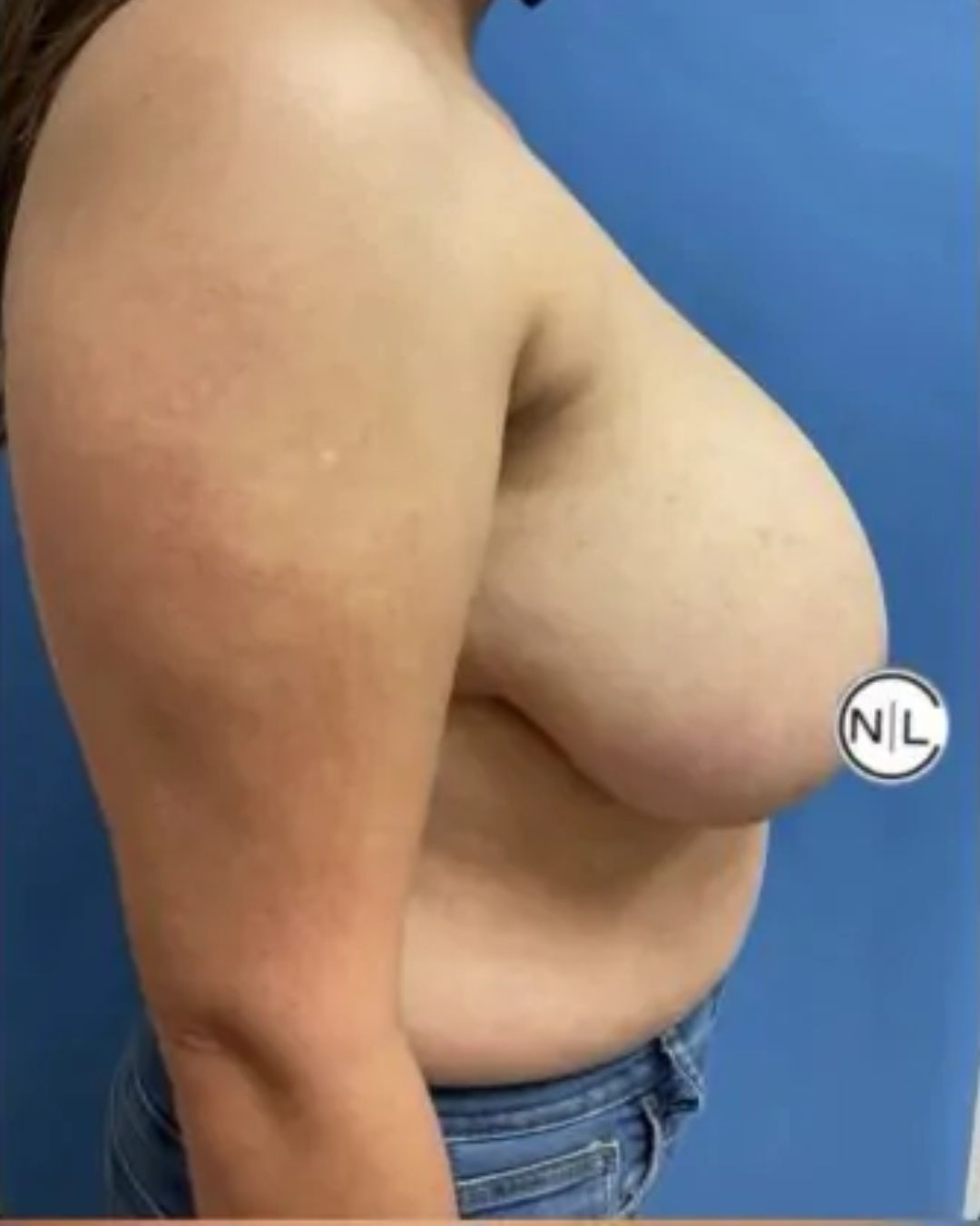 Before Breast Reduction Surgery