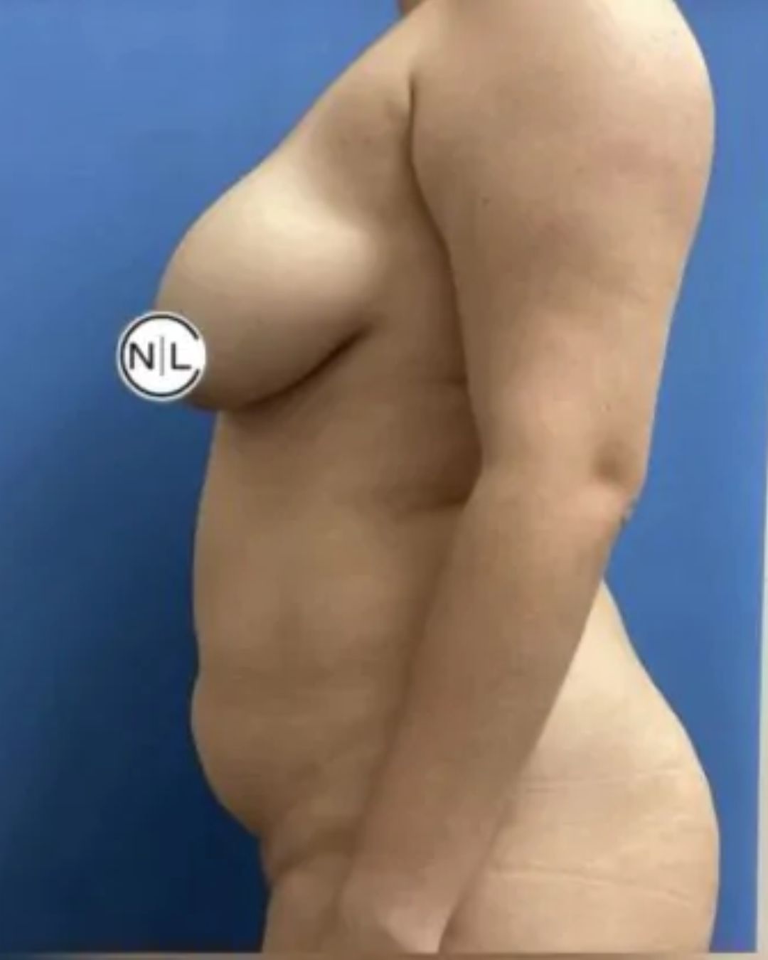 Before Breast Reduction Surgery