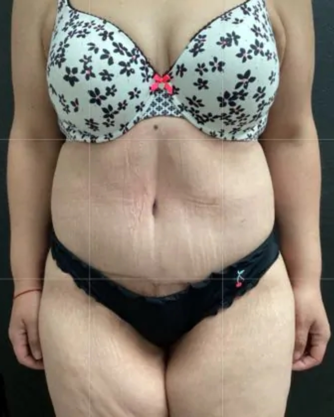 After Tummy Tuck