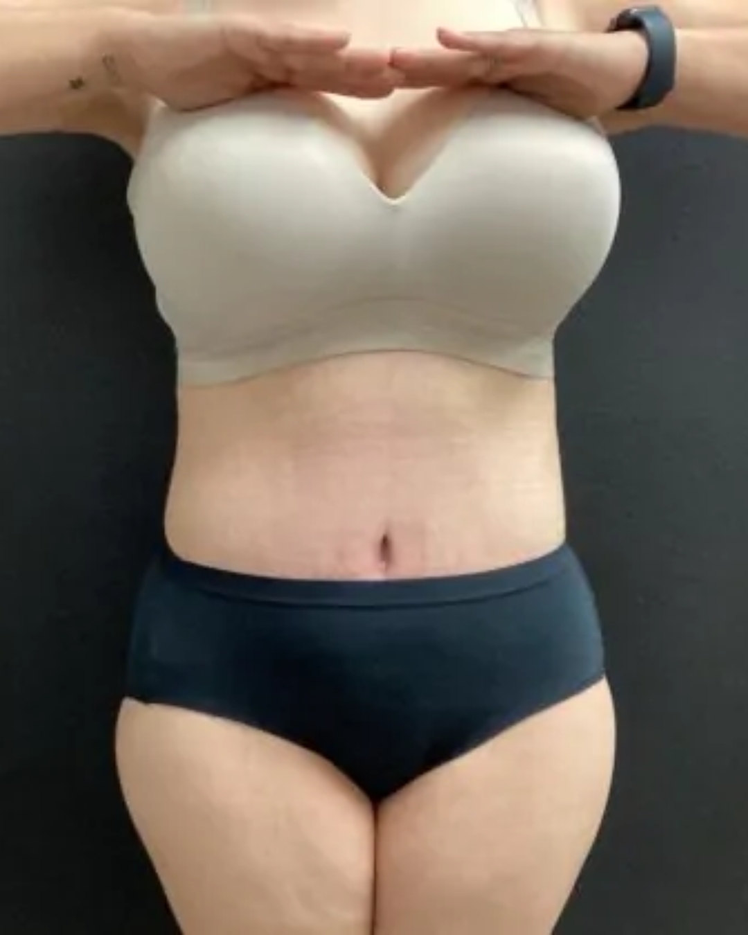 After Tummy Tuck