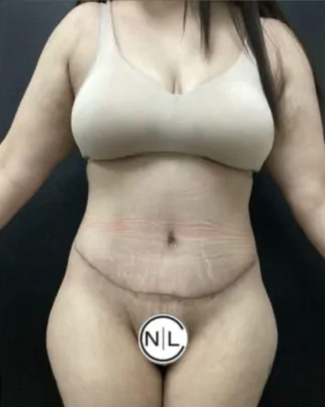 After Tummy Tuck