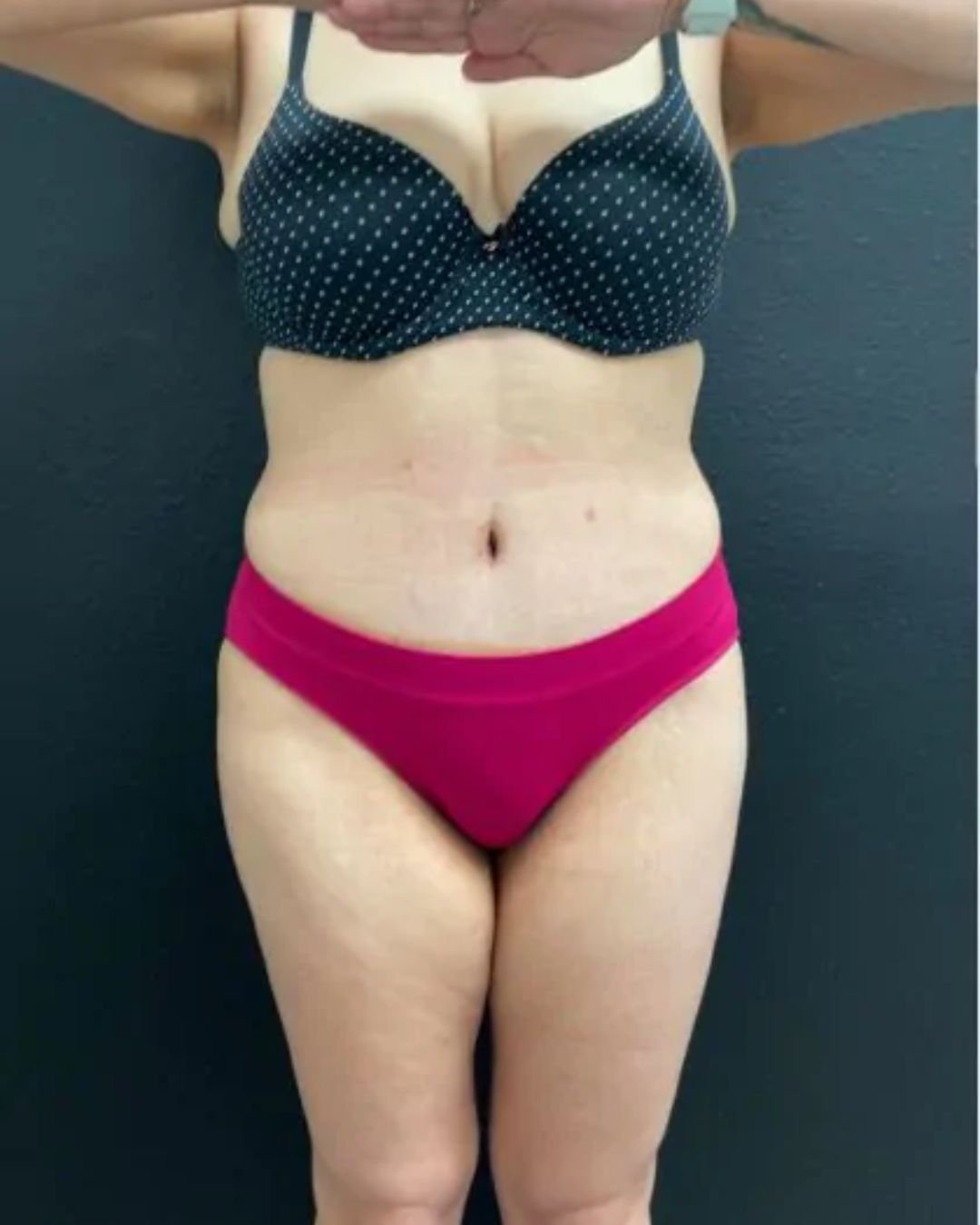 After Tummy Tuck